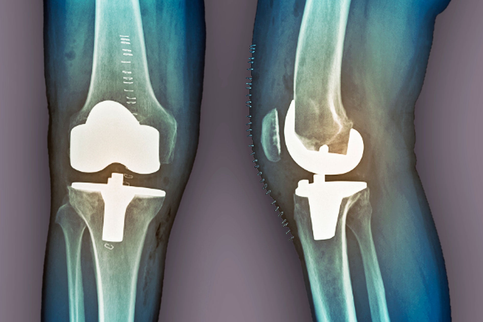 Knee Replacement Education