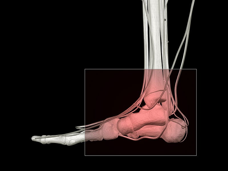 Ankle Replacement X-Ray