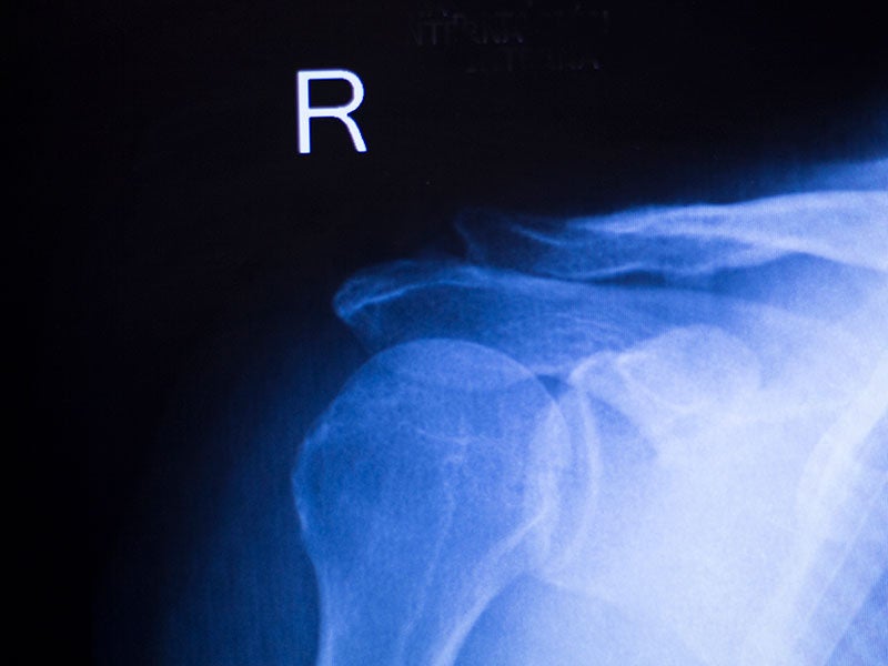 Shoulder Replacement X-Ray