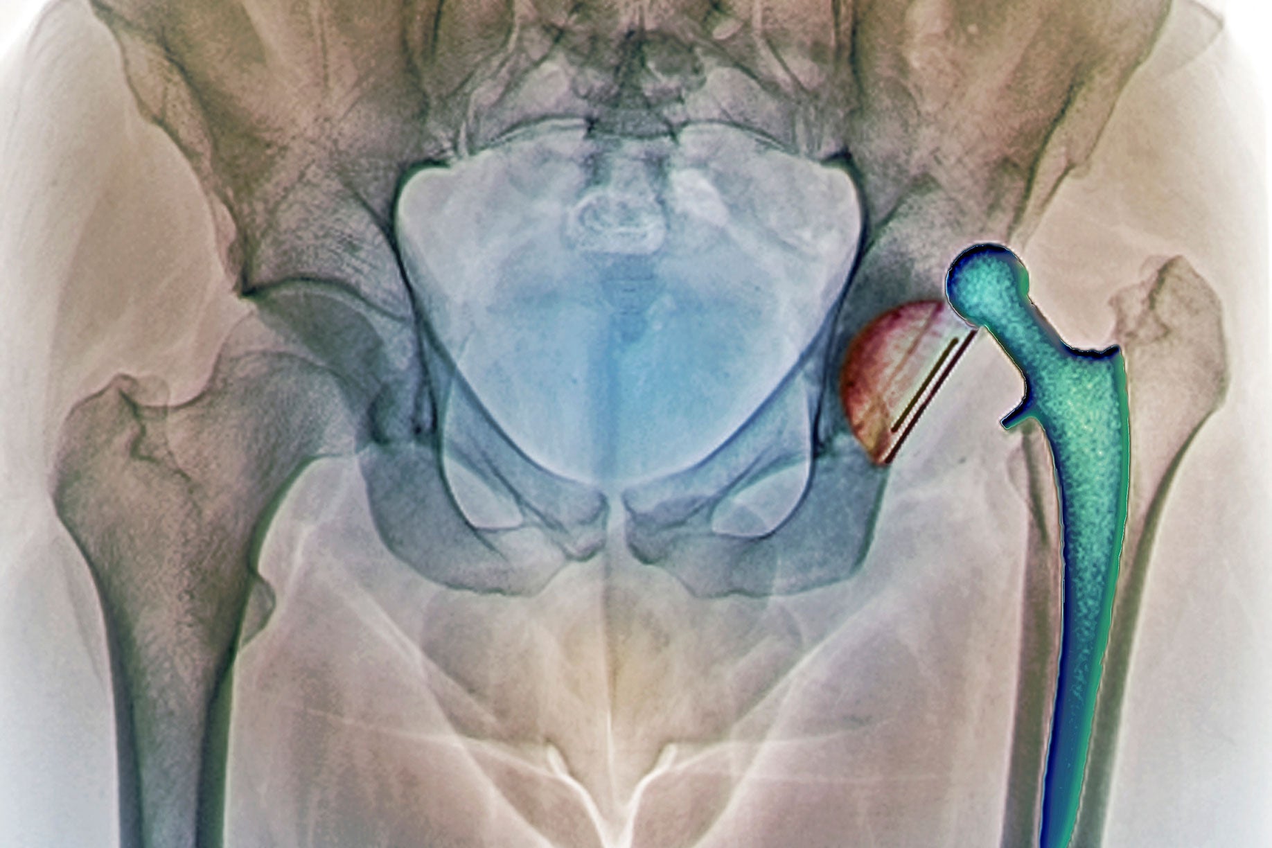 Hip Replacement Education